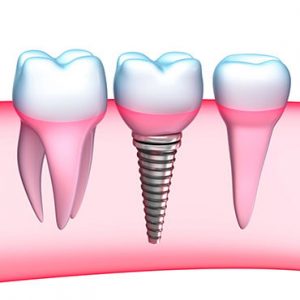 family dental centre sarnia services dental implants bg image