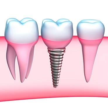 dr parekh and associates services dental implants background image